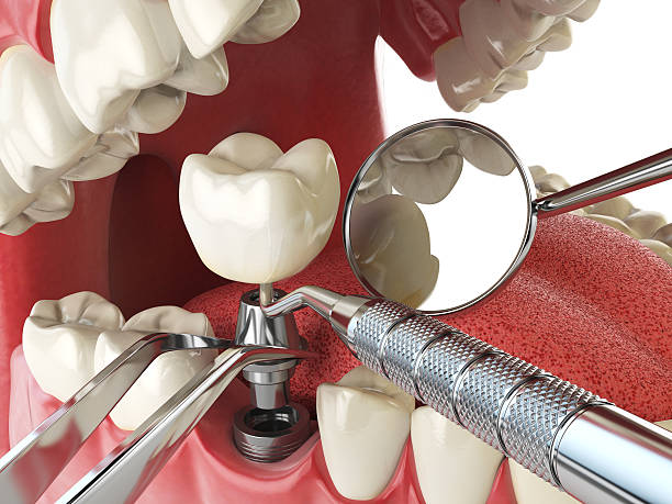 Best Emergency Wisdom Teeth Removal in Fort Meade, MD